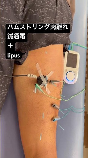 Acupuncture and electrotherapy + lipus for hamstring strain