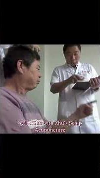 Zhu's Scalp Acupuncture Benefits Cerebellar Stroke Instantly
