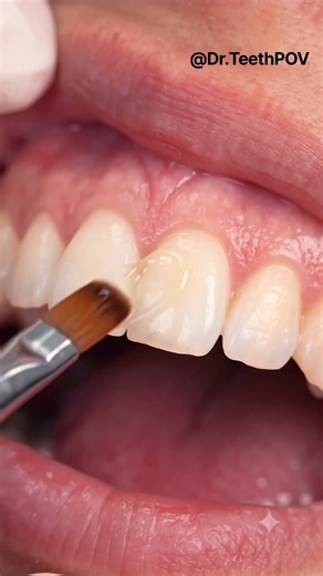 Fixing A Cavity Under The Gumline! 😱🦷 #Shorts #dentalcare #usa