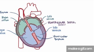 Ventricular septal defect (VSD) - repair, causes, symptoms & pathology on Make a GIF
