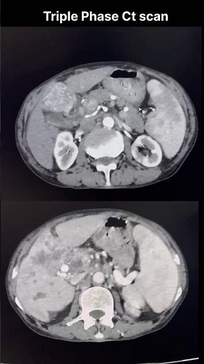 HCC on Triple Phase CT | Life-Changing Diagnosis 🤔 #shorts