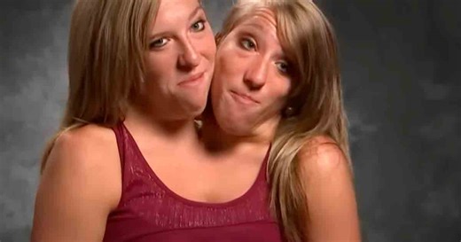 Famosas mellizas Hensel que comparten cuerpo, desatan rumores de embarazo