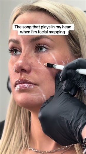 Facial Mapping Techniques for Botox and Fillers