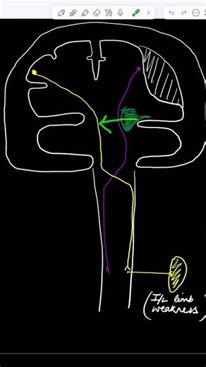 Brain Lesion Causing SAME Side Weakness?