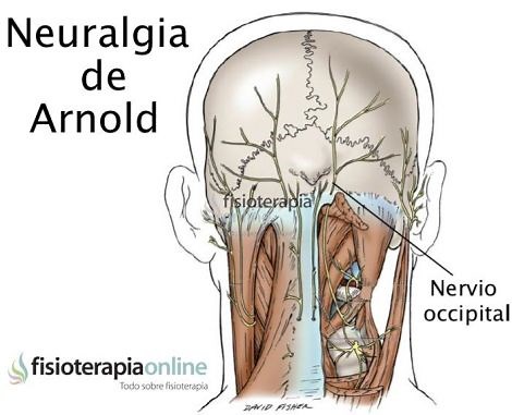 Neuralgia u occipitalgia de Arnold. Descubre sus causas, consecuencias y tratamiento