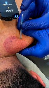💥 Dealing with stubborn muscle knots or tension that won’t let go? Dry needling targets those deep trigger points to reset the muscle, reduce inflammation, and restore mobility. It’s one of the most effective tools for pain relief and faster recovery—especially when stretching and massage aren’t cutting it. 🧠💪#DryNeedling #PainRelief #MobilityRecovery #TriggerPointTherapy #DrKyleRoss #ChicagoChiropractor | Dr_kyleross