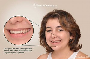 Open Bite with Natural Jaw Position Fix, No Surgery, Drilling or Braces