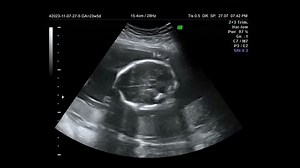 Baby Ultrasound Stock Footage Video (100% Royalty-free) 23415154 | Shutterstock