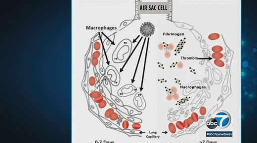 New research on 'micro-clots' could be key to preventing COVID deaths