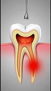 49K views · 166 reactions | Root Canal Treatment Explained in 3D | from Infection to Healing | #healthcare #ConceptionTips #healthylifestyle #fblifestyle | BodyLogic 3D | Facebook