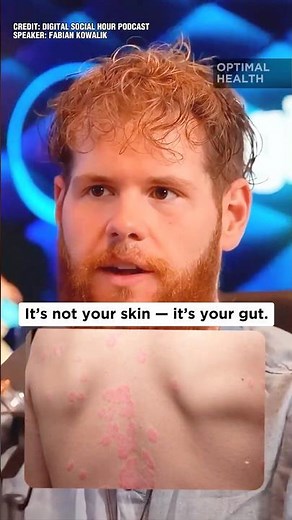 The REAL Cause of Acne & Eczema (No One Talks About This) 😳