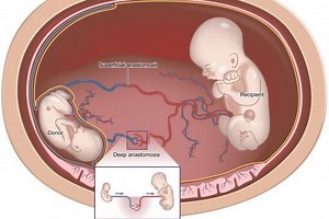 What is TTTS or Twin to Twin Transfusion Syndrome? | Emergency Live