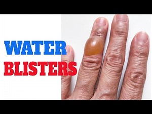What causes water blisters | Finger lumps | Skin bumps on hands | Water blisters on hands