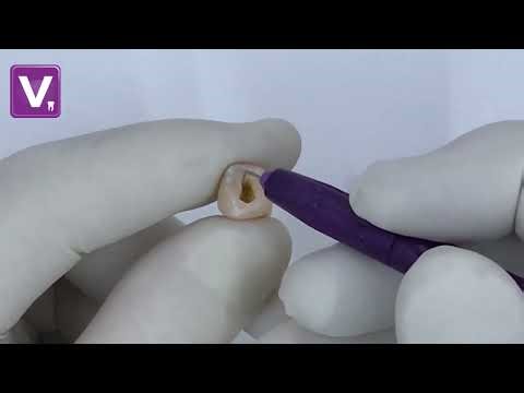 Endohandle de VentaEndo - démonstration