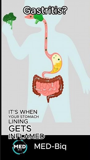 What is Gastritis? Symptoms, Types & Diagnosis Explained in 30 Seconds