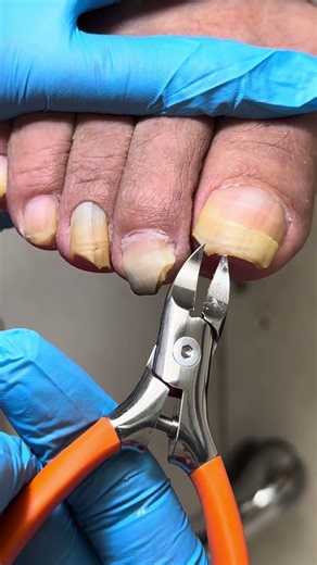 Five Toenails Can Be Easily Trimmed! #satisfying #nails