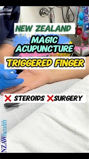 Trigger Finger Relief Without Steroids injection/Surgery | TCM Micro-Needle Release in Minutes