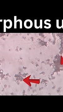 Amorphous urates in urine | ‪@medicallabtechnologysajal6903‬