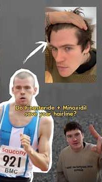 Will Finasteride and Minoxidil bring your hairline back?