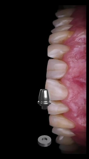 Transform Your Smile with Dental Implants at Ace Dental