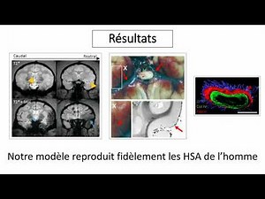 Les hémorragies sous-arachnoïdiennes perturbent de façon majeure