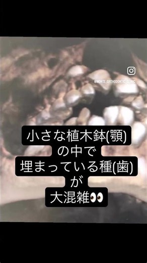 上顎犬歯による歯根吸収を起こさないために #歯根吸収から歯を守る #小児矯正を行う目的は