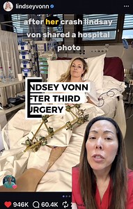 After her third surgery, Lindsey Vonn shared a hospital photo showing a spanning external fixator on her left leg. I am not involved in her care and have no information beyond what has been publicly shared. This is general orthopaedic education. An external fixator is a temporary stabilizing frame placed outside the body. Pins go into bone above and below the fracture and are connected to an external bar to hold alignment while protecting injured soft tissues. Why not fix it internally right awa