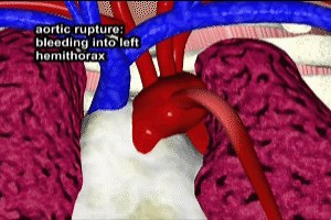 Hemothorax in Aortic Dissection Video - Trial Image Inc.