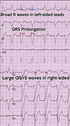 Left bundle branch block (LBBB) ECG: Example 7
