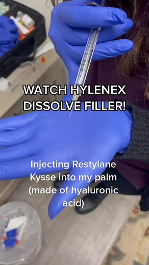 How hylenex dissolved filler #lipfiller #hylenex #dissolvingfiller #injector #botox #dysport #restylane