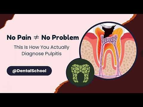 How to Diagnose Pulp Conditions – Reversible, Irreversible, or Necrosis?