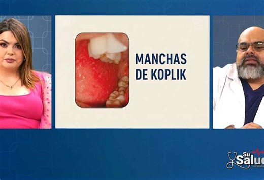 Manchas de Koplik: el síntoma que diferencia el sarampión de otras enfermedades | Teletica