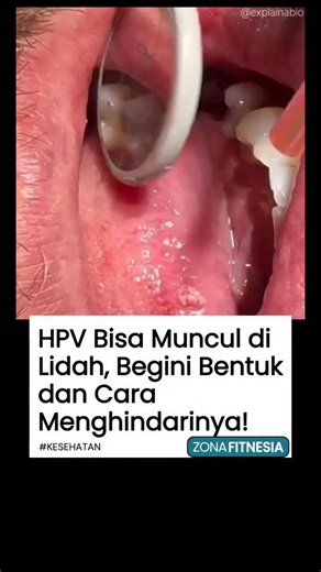 Lesi di sisi lidah bisa disebabkan oleh Human Papillomavirus (HPV), virus umum yang menyerang kulit dan selaput lendir di mulut, tenggorokan, dan area genital. HPV membuat sel lidah tumbuh tidak normal, membentuk benjolan kecil seperti kutil.