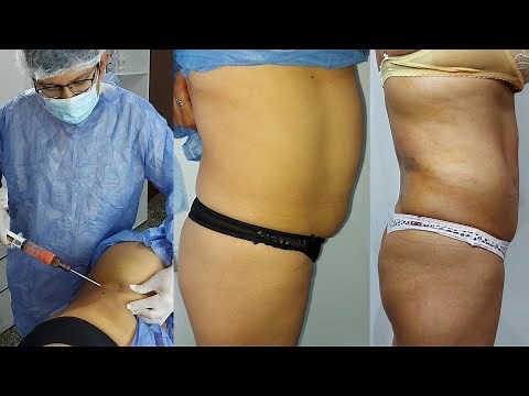 Lipoescultura MELA 2021🔥 : Curso de Mini Extracción lipídica ambulatoria | antes y después
