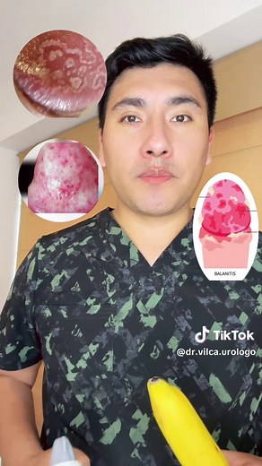 Circuncisión y su eficacia en el tratamiento de la balanitis