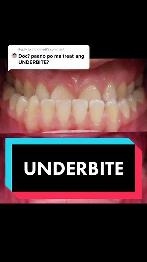Underbite Treatment: Braces, Surgeries, and Correction Methods