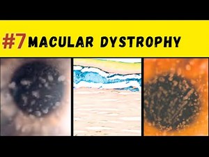 Macular Corneal Dystrophy: Keratan sulfate antigenicity, clinical course, management