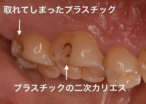 虫歯治療の繰り返し！二次（２次）カリエスを防ぐ９つの予防法