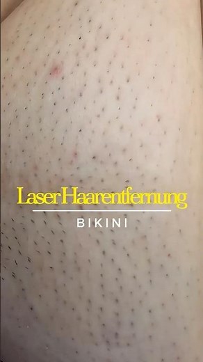 ★ Laser-Haarentfernung: Bikini Vorher & Nachher | 1 ★ Laser Hair Removal: Bikini Before & After 1 ★