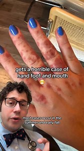 @Syd 🤎 Lifestyle • Mama What is hand, foot, and mouth disease? What are the signs and symptoms of hand, foot, and mouth disease? How is hand, foot, and mouth disease treated? How to prevent hand, foot, and mouth disease? #handfootandmouthdisease #rash #tiktokdoc #parentsoftiktok #LearnOnTikTok | Zachary Rubin, MD