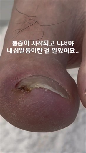 절뚝일 정도로 통증 유발하던 #내성발톱 💦 편안한 발걸음 하시도록 정성스러운 교정 관리로 개선해 드렸습니다🥰 #조원장의풋솔루션 #레푸스동탄역점 #레푸스상도점 #레푸스성남태평점