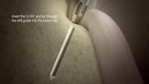 Q-FIX CURVED All-Suture Anchor Technique Animation (Hip)