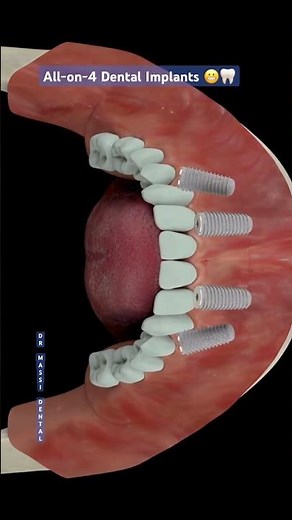 ALL-ON-4 DENTAL IMPLANTS 😁🦷 | A Full Smile with Just 4 Implants