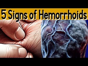 5 signs and symptoms of Hemorrhoids and treatment