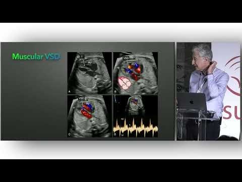 14SESSION 4 Anomalies of the AV valves and rhythm disorders Atrial and ventricular septal defects