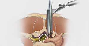 97K views · 266 reactions | Minimally invasive spine surgery, when necessary, helps patients recover faster. https://mayocl.in/2Ytidt9 | Mayo Clinic | Facebook