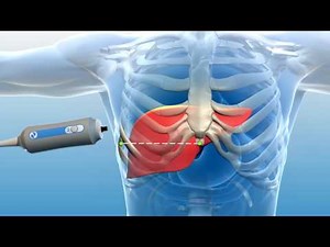 A Patient's Introduction to FibroScan