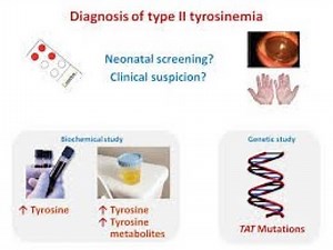 Tyrosinemia Type II Caused by Deficiency Of Tyrosine aminotransferase Or Richner Hanhart syndrome