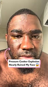 95K views · 187 reactions | Pressure cooker explosion nearly ruined my face  #fblifestyle | Four Nine | Facebook