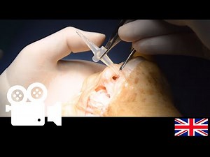 Rheumatoid hand: Metacarpophalangeal joint silicone implant revision surgery.